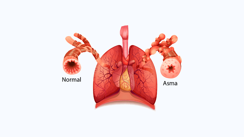 via aerea normal e asmática